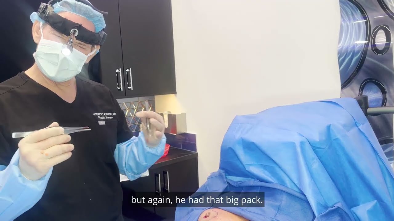 Gynecomastia tissue removal procedure in progress.