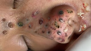 Loan Nguyen Acne Treatment 127c