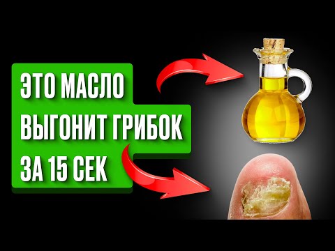 Как я навсегда избавилась от ГРИБКА НОГТЕЙ простым… за 15 сек? Это МАСЛО есть у каждого