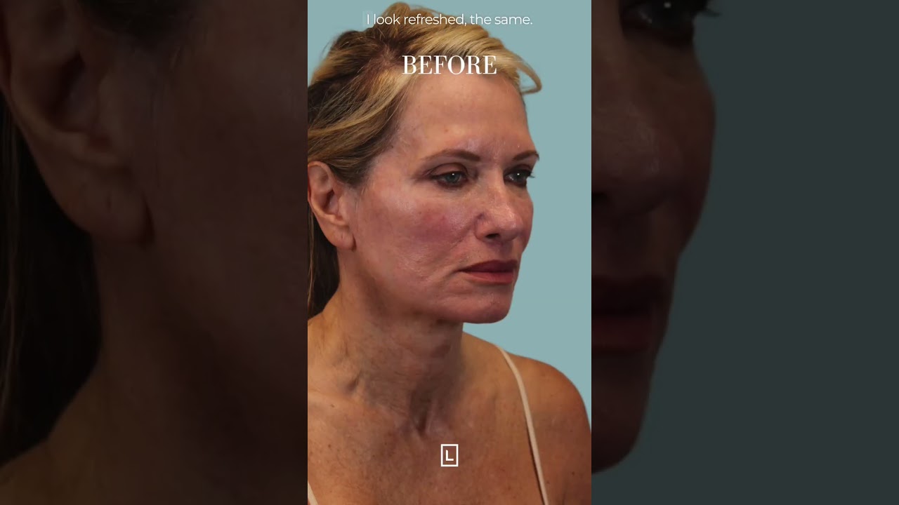 rhinoplasty journey
