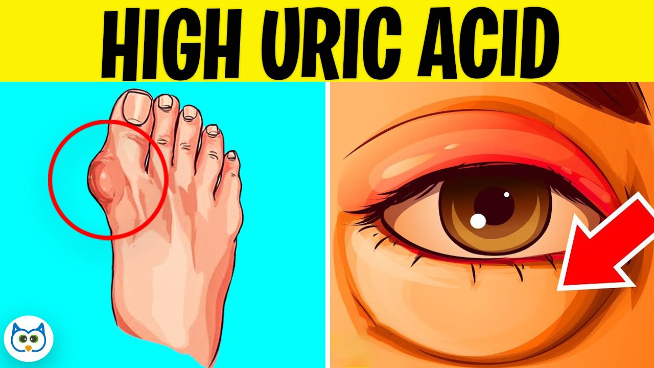 7 Symptoms of High Uric Acid Levels In The Body | Gout Symptoms￼
