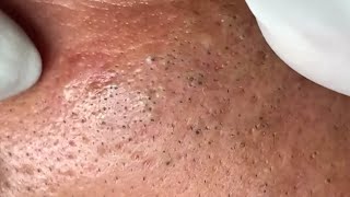 Blackheads & Whiteheads Satisfying Removal Acne and Pimple @0788