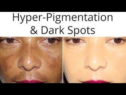 Remove Pigmentation in 3 days | चेहरे की झाइयां दाग धब्बे 3 दिन में गायब हो जायेंगे बस ये लगा लो !