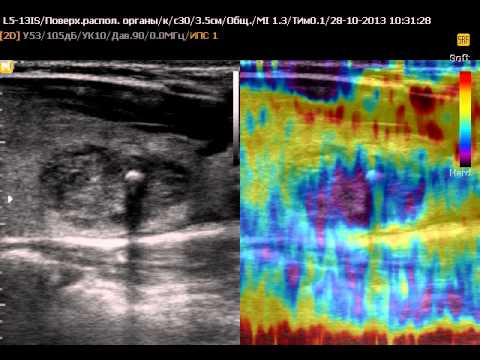 Узи щитовидной железы с эластографией. Эластография щитовидной железы. Эластография узлов щитовидной железы. Компрессионная эластография щитовидной железы. Эластография сдвиговой волны щитовидной железы.