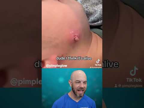 You've GOT to see this super infected cyst removal🫣 (credit: @pimpleglow on TT) #cyst #s#satisfying