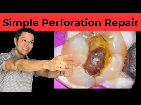 Perforation Repair SECRETS Every Dentist Needs to Know!