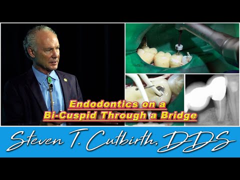 Endodontics on a Mandibular Bi-Cuspid Through a Bridge - Dental Minute with Steven T. Cutbirth, DDS