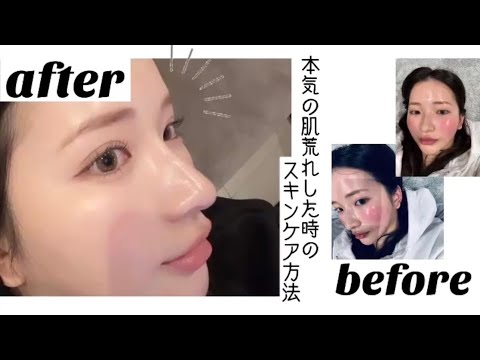 【スキンケア】NO案件❌肌荒れ最新スキンケア🫧レスキューアイテム🧖🏻‍♀️🥚赤み/乾燥/酒さ