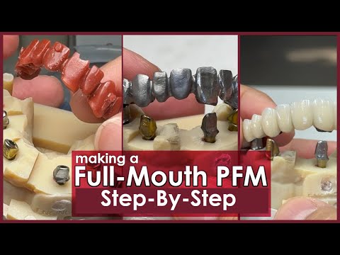 Step-By-Step: Making a Full-Mouth PFM