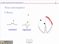 ECG Waveforms and Arrhythmias