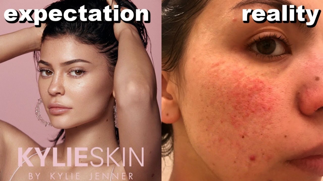 Kylie skin irritated my skin. My final results - Audrey Victoria