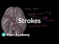 Understanding Strokes: Ischemic and Hemorrhagic