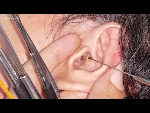 耳ワックス除去ガイド (07)