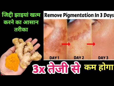 झाइयां हटाने का कमल का तरीका II Reduce Melasma, Pigmentation, Discoloration, Blackspots