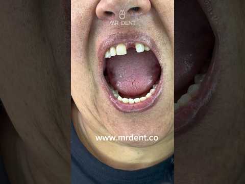 When a tooth falls out this is the best #mrdent -#dentist #smile #dentalesthetics #dentures