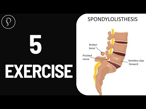 Top 5 Exercises for Spondylolisthesis | Relieve Pain & Strengthen Your Spine | dr. harish grover