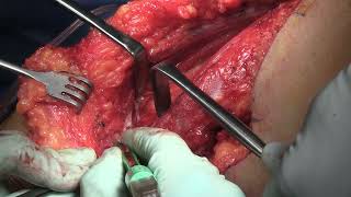 Infraclavicular brachial plexus exposure