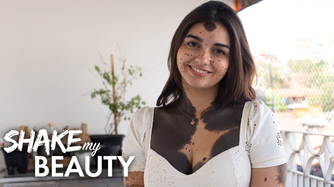 I'm 80% covered in birthmarks - shake my beauty
