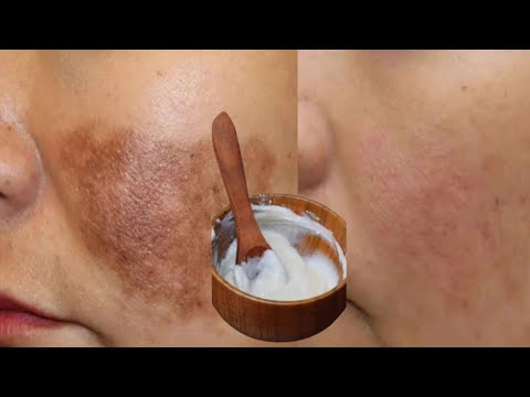 सिर्फ 1 चीज मिलाकर लगाए,फेशियल से 1000 गुना ज्यादा ग्लो देख हैरान हो जाओगे,get glowing skin,fairness