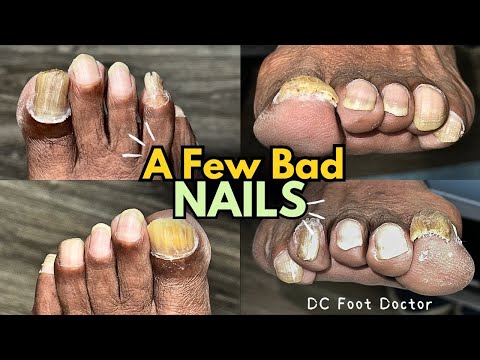 A Few Bad Nails: Trimming Fungal Toenails