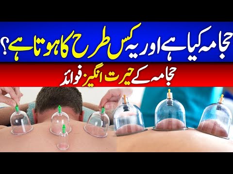 HIJAMA FOR BACK PAIN | BENEFITS OF HIJAMA CUPPING THERAPY