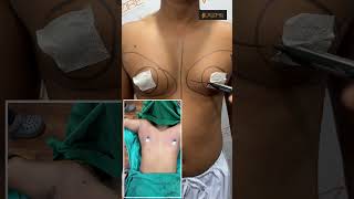 Gynecomastia Result | Gynecomastia Treatment