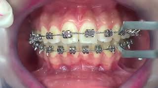 How to Properly Blow and Remove Braces If You Have Braces