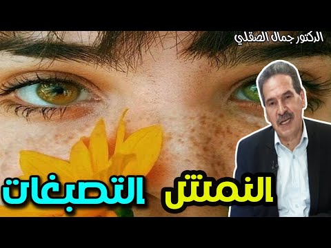 النمش و تصبعات البشرة   -   الدكتور جمال الصقلي   -