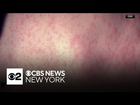 YouTube video thumbnail: Measles Case Reported in Ocean County, New Jersey, Health Officials Say