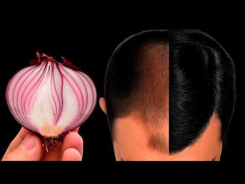 Zwiebelsaft für extremes Haarwachstum! Stoppen Sie Haarausfall