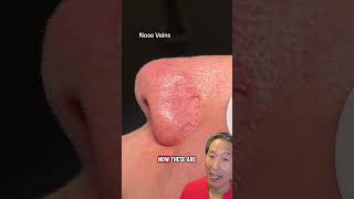 These Laser Treatments Ate!