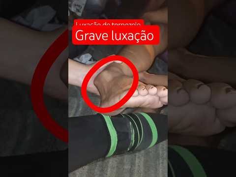 🚨 Tornozelo Saiu do Lugar? Luxação de Tornozelo: Sintomas e Primeiros Socorros #viralbrasil #shorts