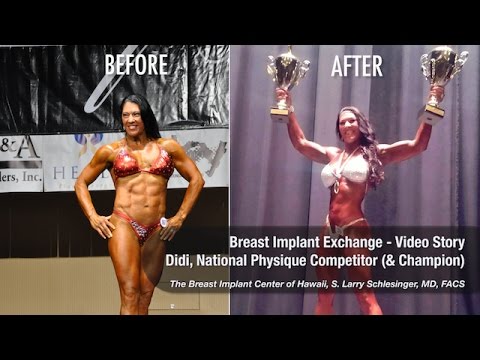 Breast Implant Exchange Review from National Physique Champion, Didi Hall - Breast Implant Center of Hawaii