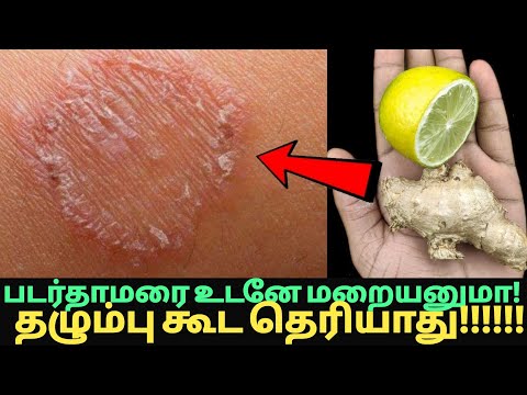 1 மணி நேரத்தில் படர்தாமரை,அரிப்பு,படை காணாமப் போகும்!remedy for ring worm,padar thamarai tips tamil
