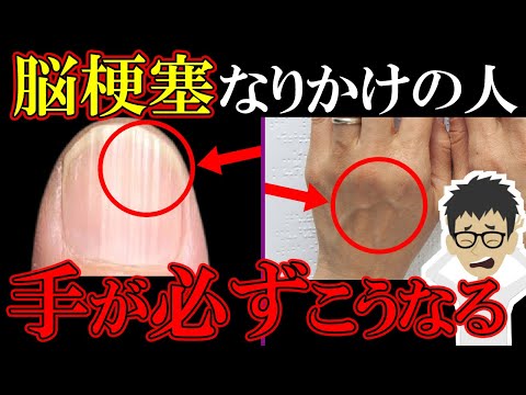 恐ろしい脳梗塞！絶対に見逃してはいけない危険なサイン8選【症状｜前兆｜原因｜脳卒中｜脳出血｜くも膜下出血】