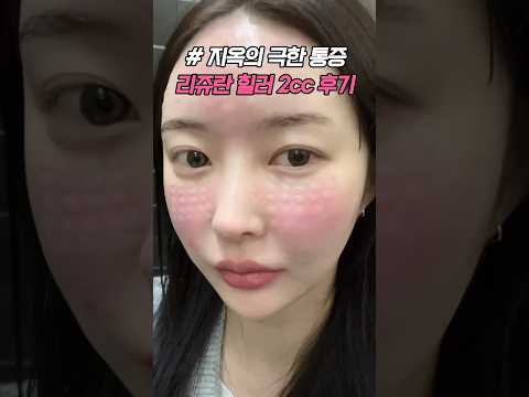 리쥬란힐러 2cc 2일간의 피부 변화 (내돈내산)