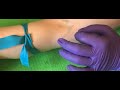 Tourniquet Application and Venipuncture Techniques