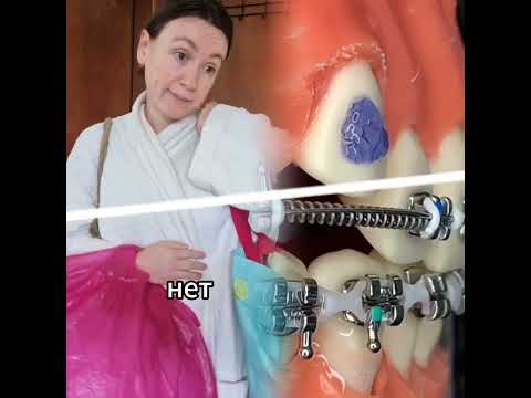 #braceslife #foryou #funny #braces #pov #storytime #mybracesjourney #fyr #allaboutbraces #smile