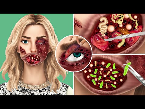 ASMR Remove Giant Acne & Worm & maggot Infected Eyes & Face  | Skincare |ASMR| Animation|Satisfying