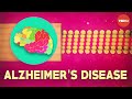 Understanding Alzheimer's Disease