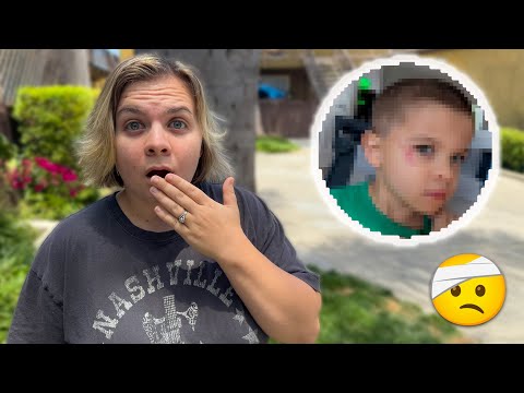 What Happened To His Face?! 🤕
