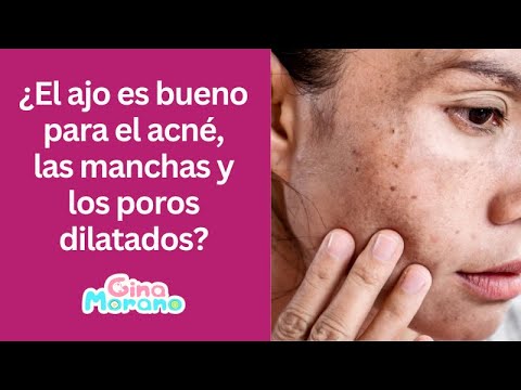 ¿El ajo es bueno para el acné, las manchas y los poros dilatados?