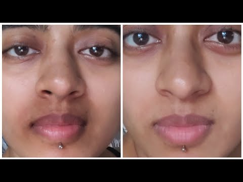 How I ACTUALLY got Rid of Pigmentation Around my Mouth || Pigmentation Treatment For Mouth Darkness