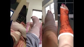 My Ankle Recovery (The Full Story w/ Pictures)