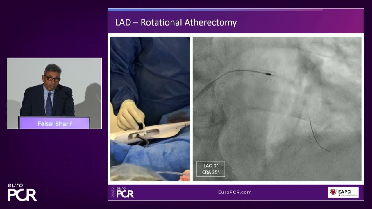 Simplifying complex coronary