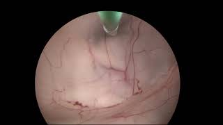 Ventriculocystostomy of Intraparenchymal Cyst with the LOTTA® Ventriculoscope