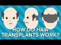 Hair Transplant Knowledge Assessment
