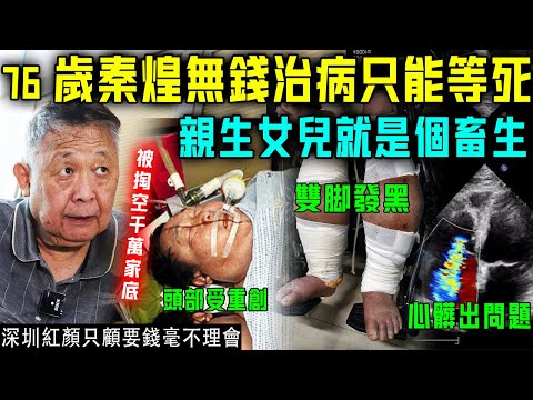 聞者心酸！ 76歲秦煌只能等死？被女兒掏空千萬家底，晚年住院冇錢治病！頭部受重傷，雙腳腫脹發黑，就連心臟都出大問題！【星娛樂】