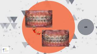 Case khớp cắn hạng II tiểu loại 1 hiệu ứng cuộn / Class II div 1 case- bowing effect resolve with UA