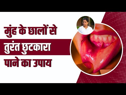 मुंह के छालों (Mouth Ulcers) से तुरंत छुटकारा पाने का उपाय || Acharya Balkrishna